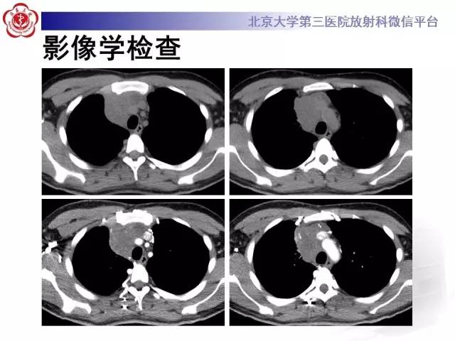 【病例】前纵隔肿瘤3例CT影像诊断