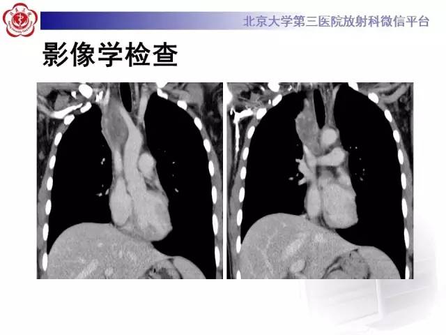 【病例】前纵隔肿瘤3例CT影像诊断