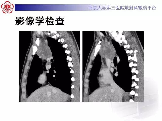 【病例】前纵隔肿瘤3例CT影像诊断