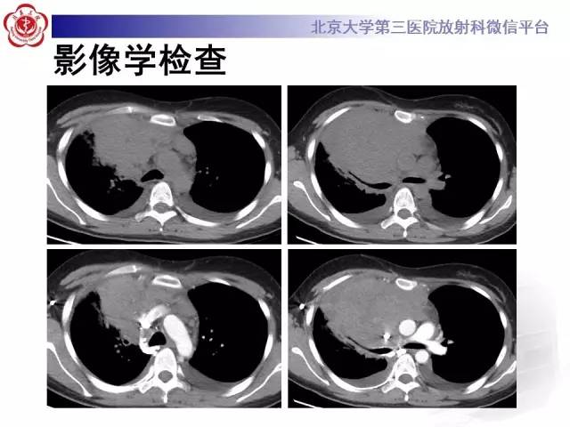 【病例】前纵隔肿瘤3例CT影像诊断