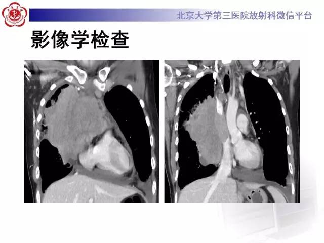 【病例】前纵隔肿瘤3例CT影像诊断