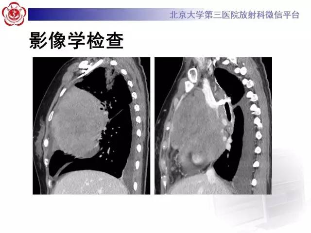【病例】前纵隔肿瘤3例CT影像诊断