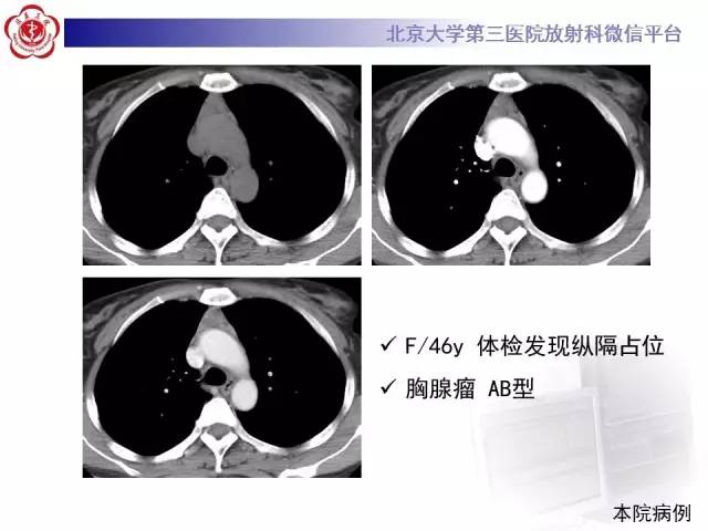 【病例】前纵隔肿瘤3例CT影像诊断