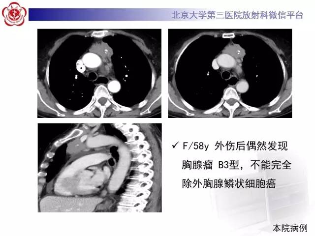 【病例】前纵隔肿瘤3例CT影像诊断