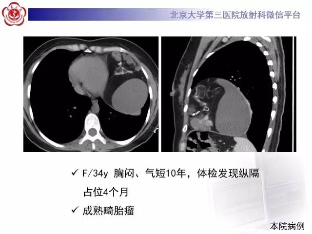 【病例】前纵隔肿瘤3例CT影像诊断