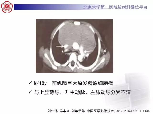 【病例】前纵隔肿瘤3例CT影像诊断