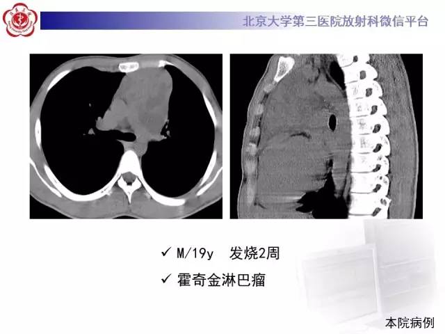 【病例】前纵隔肿瘤3例CT影像诊断