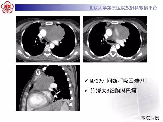 【病例】前纵隔肿瘤3例CT影像诊断