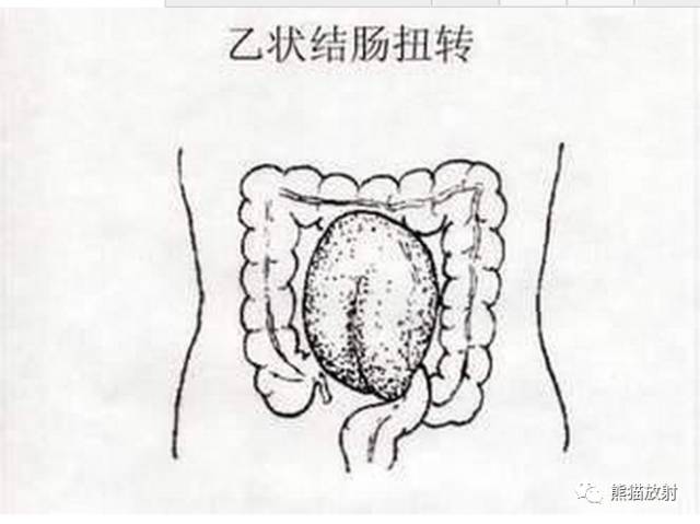 腹部平片——肠扭转,大肠梗阻,中毒性巨结肠,腹膜后积气 腹部平片——肠扭转,大肠梗阻,中毒性巨结肠,腹膜后积气