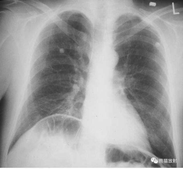 腹部平片——肠扭转,大肠梗阻,中毒性巨结肠,腹膜后积气 腹部平片——肠扭转,大肠梗阻,中毒性巨结肠,腹膜后积气