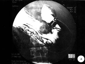 【病例】胃体低度恶性间质肿瘤1例CT