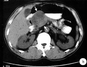 【病例】胃体低度恶性间质肿瘤1例CT