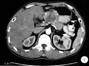 【病例】胃体低度恶性间质肿瘤1例CT
