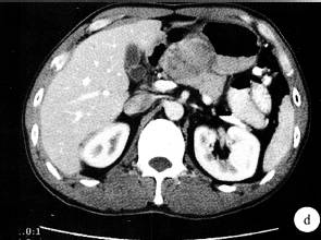 【病例】胃体低度恶性间质肿瘤1例CT