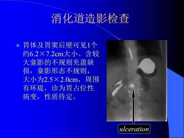 【病例】胃窦溃疡型癌肉瘤1例CT影像表现 【病例】胃窦溃疡型癌肉瘤1例CT影像表现