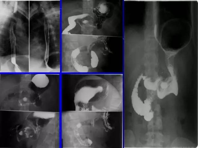 【病例】胃窦溃疡型癌肉瘤1例CT影像表现 【病例】胃窦溃疡型癌肉瘤1例CT影像表现