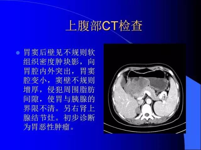 【病例】胃窦溃疡型癌肉瘤1例CT影像表现 【病例】胃窦溃疡型癌肉瘤1例CT影像表现