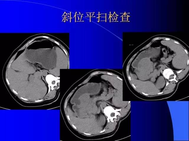 【病例】胃窦溃疡型癌肉瘤1例CT影像表现 【病例】胃窦溃疡型癌肉瘤1例CT影像表现