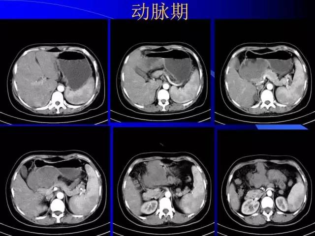【病例】胃窦溃疡型癌肉瘤1例CT影像表现 【病例】胃窦溃疡型癌肉瘤1例CT影像表现