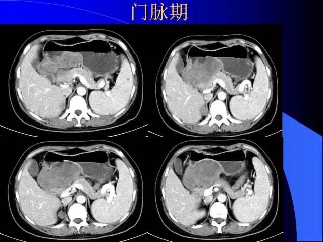 【病例】胃窦溃疡型癌肉瘤1例CT影像表现 【病例】胃窦溃疡型癌肉瘤1例CT影像表现