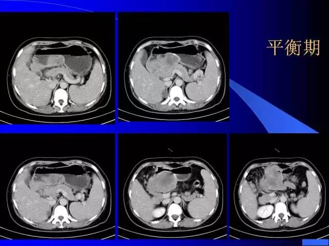 【病例】胃窦溃疡型癌肉瘤1例CT影像表现 【病例】胃窦溃疡型癌肉瘤1例CT影像表现