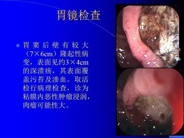 【病例】胃窦溃疡型癌肉瘤1例CT影像表现 【病例】胃窦溃疡型癌肉瘤1例CT影像表现