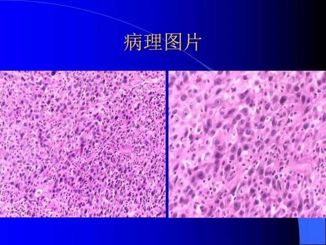 【病例】胃窦溃疡型癌肉瘤1例CT影像表现 【病例】胃窦溃疡型癌肉瘤1例CT影像表现