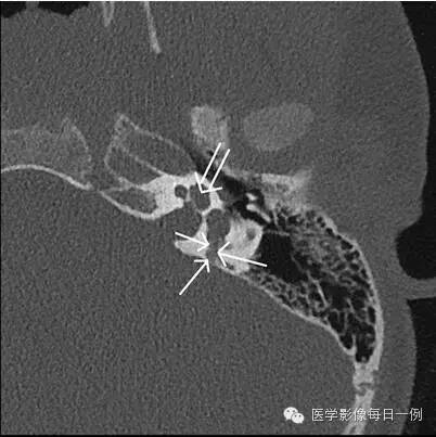 【病例】内耳Mondini畸形1例CT及MR影像表现