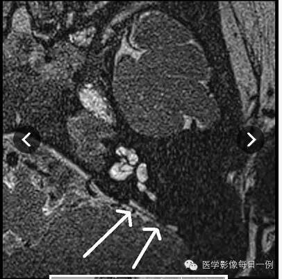 【病例】内耳Mondini畸形1例CT及MR影像表现