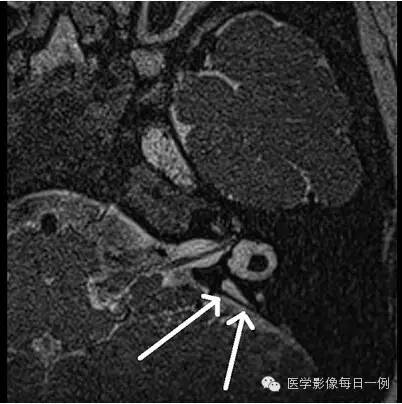 【病例】内耳Mondini畸形1例CT及MR影像表现
