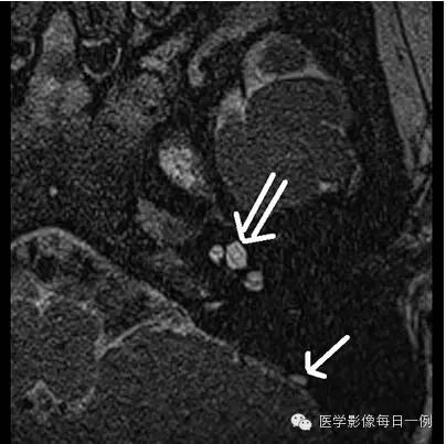 【病例】内耳Mondini畸形1例CT及MR影像表现