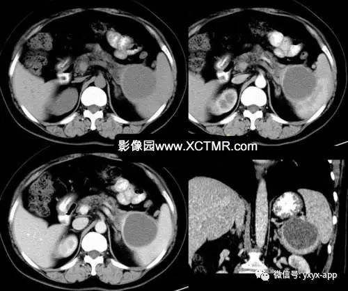 【病例】胰腺假性囊肿3例CT