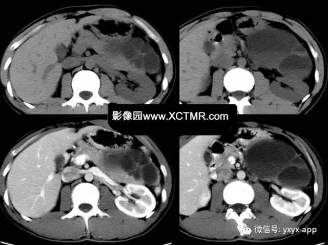 【病例】胰腺假性囊肿3例CT 【病例】胰腺假性囊肿3例CT