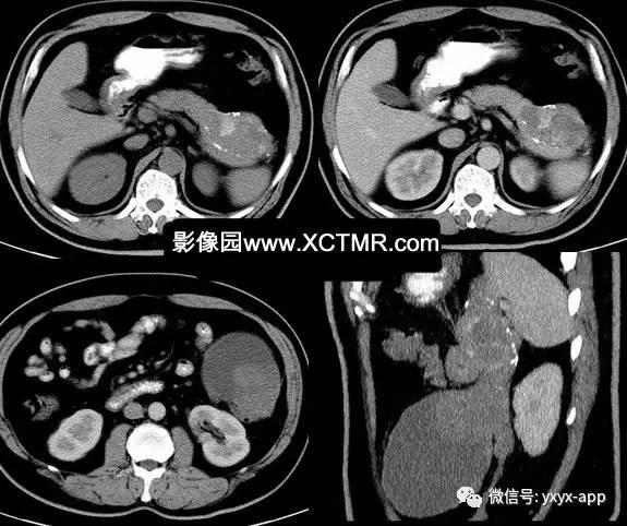 【病例】胰腺假性囊肿3例CT 【病例】胰腺假性囊肿3例CT