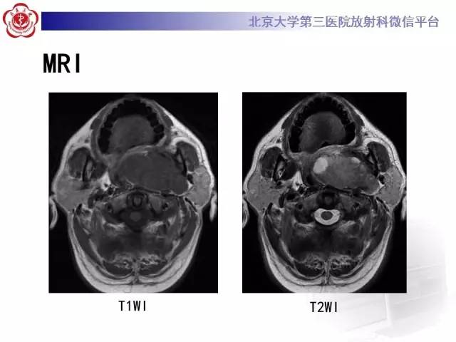 【病例】咽旁间隙多形性腺瘤1例MR