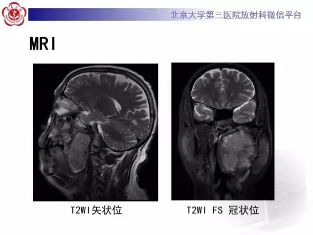 【病例】咽旁间隙多形性腺瘤1例MR