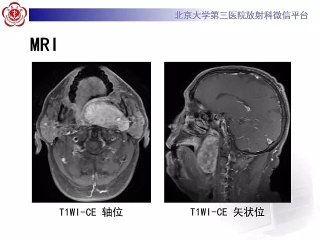 【病例】咽旁间隙多形性腺瘤1例MR