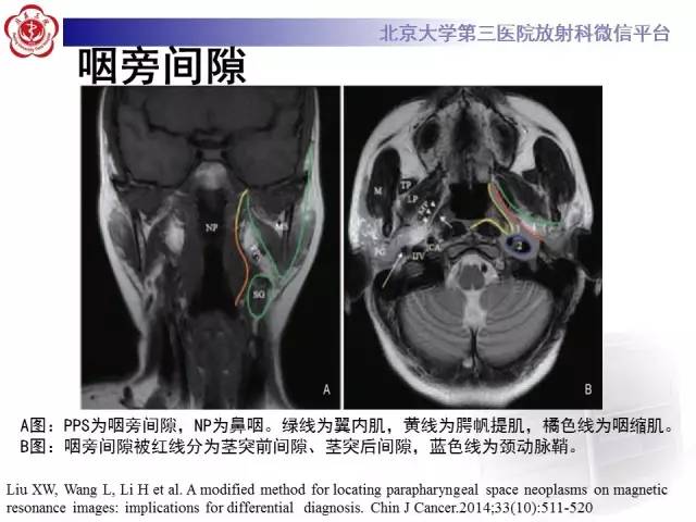 【病例】咽旁间隙多形性腺瘤1例MR