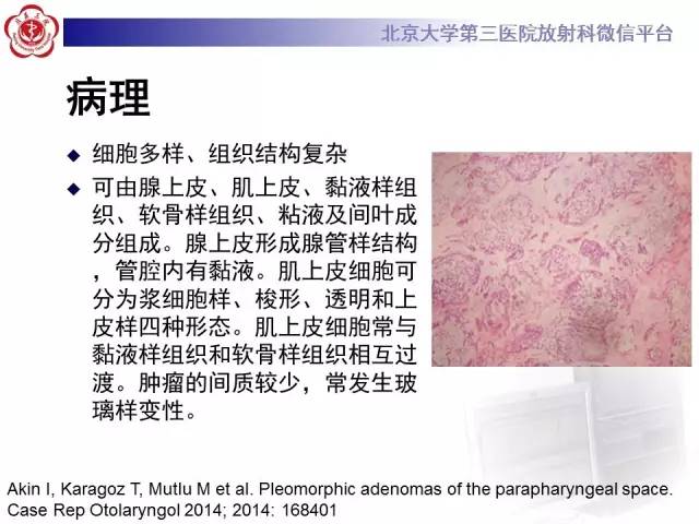 【病例】咽旁间隙多形性腺瘤1例MR