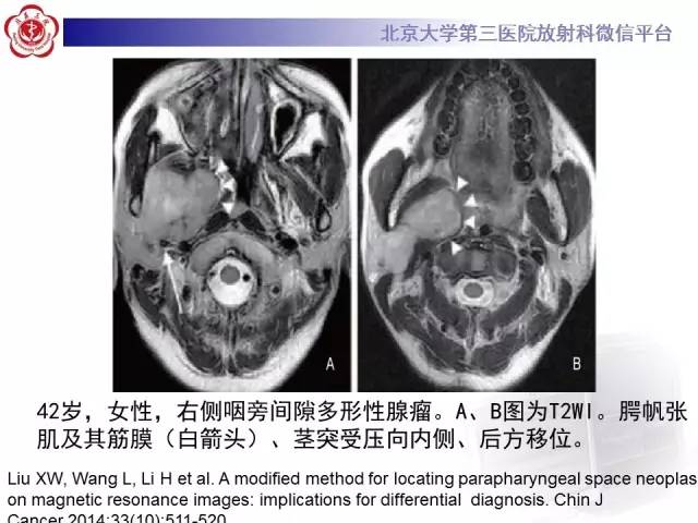 【病例】咽旁间隙多形性腺瘤1例MR