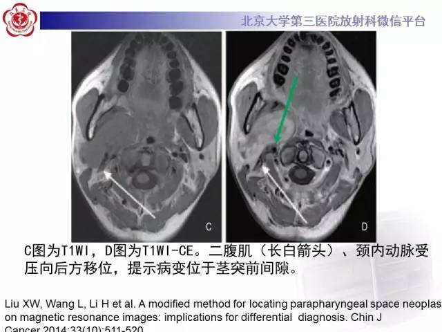 【病例】咽旁间隙多形性腺瘤1例MR