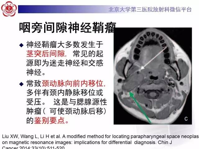 【病例】咽旁间隙多形性腺瘤1例MR
