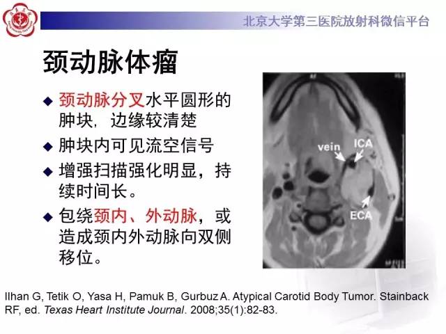 【病例】咽旁间隙多形性腺瘤1例MR