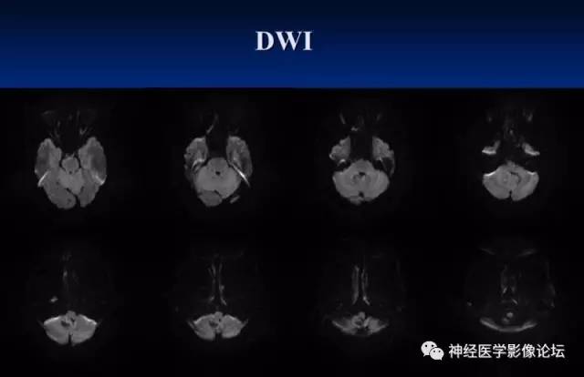 【病例】右侧小脑半球血管母细胞瘤1例CT及MR影像讨论