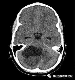 【病例】右侧小脑半球血管母细胞瘤1例CT及MR影像讨论