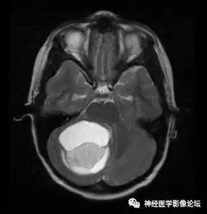 【病例】右侧小脑半球血管母细胞瘤1例CT及MR影像讨论