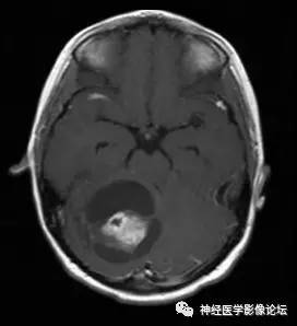 【病例】右侧小脑半球血管母细胞瘤1例CT及MR影像讨论