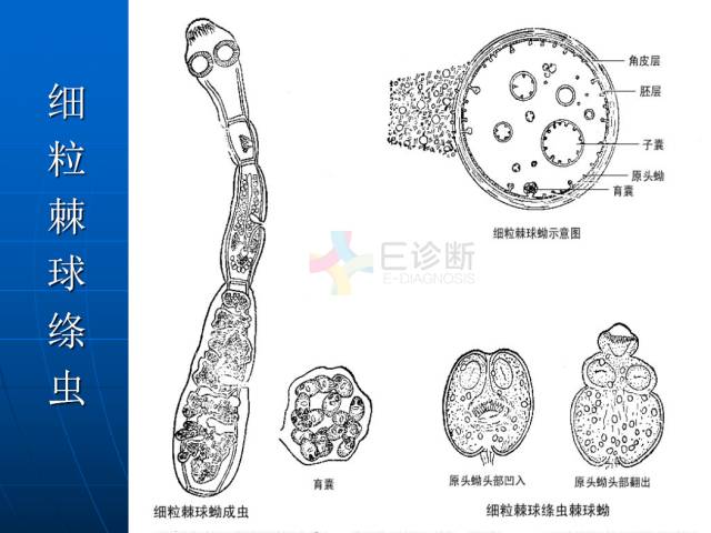 【PPT】肝包虫CT诊断