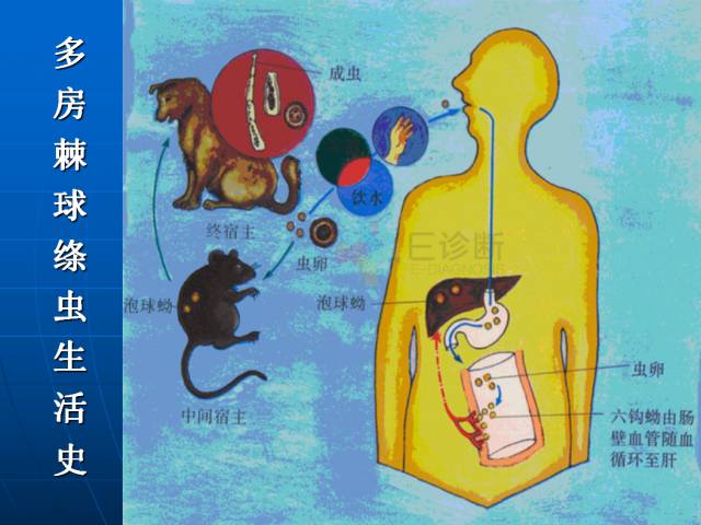 【PPT】肝包虫CT诊断
