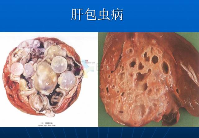 【PPT】肝包虫CT诊断